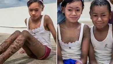 OMG! इन बच्चों की त्वचा है सांप की जैसे, उसे उतार देता है हर 10 दिन में